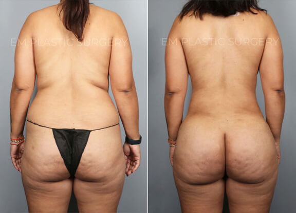 Liposuction Surgery Before & After
