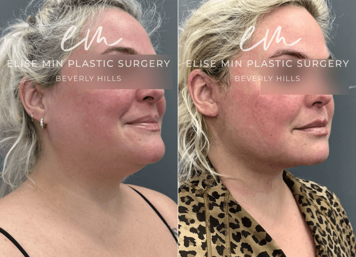 This is a 38-year-old woman who desired improved neck definition while maintaining harmony with her overall aesthetic. She underwent a neck lift with platysmaplasty, achieving a more sculpted and defined neck contour that complements the rest of her features.