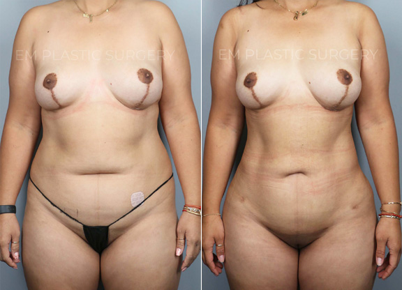 360 Liposuction Surgery Before & After