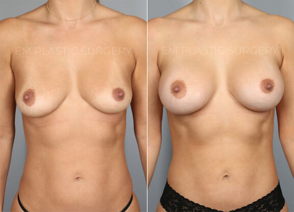 Breast Augmentation Surgery Before & After