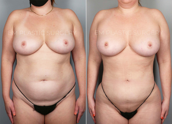 360 Liposuction Surgery Before & After