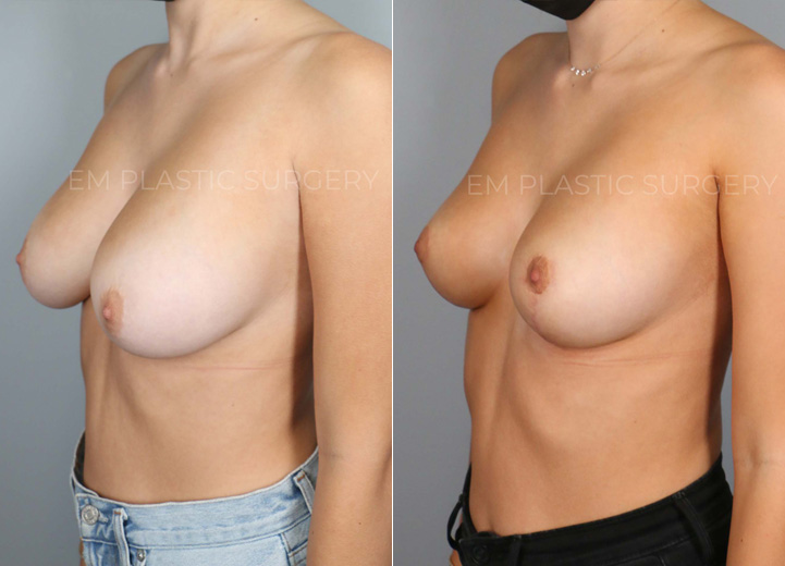 This is a 22 year-old woman with 32DD breasts who felt that her breasts did not match her
petite torso. She was experiencing neck and back pain and ideally wanted to be a C cup. The
patient underwent a small breast reduction (130g removed from each breast), which included a
breast lift procedure. She had the procedure done using a minimal scar approach with a lollipop
incision. This is a good example that every breast reduction patient receives a breast lift
procedure to achieve perkier breasts.