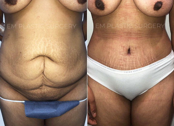 Tummy Tuck Surgery Before & After