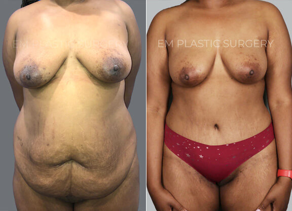 Tummy Tuck Surgery Before & After