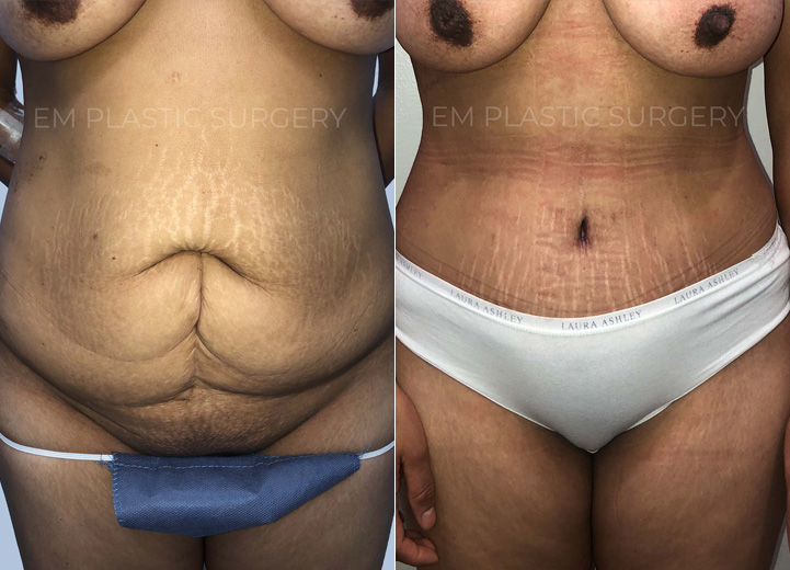 This is a 42-year-old woman who had multiple pregnancies in the past and had a complication
during one of her deliveries requiring an open abdominal surgery. Unfortunately, the surgery
resulted in significant scarring of her lower abdomen. She came to me wanting to get rid of the
extra belly tissue and scars. She underwent a full abdominoplasty with rectus plication. She was
so happy to have her flat abdomen back. Not only is her abdominal scar fully removed but a
good chunk of her stretch marks were also been removed, which was a nice plus.