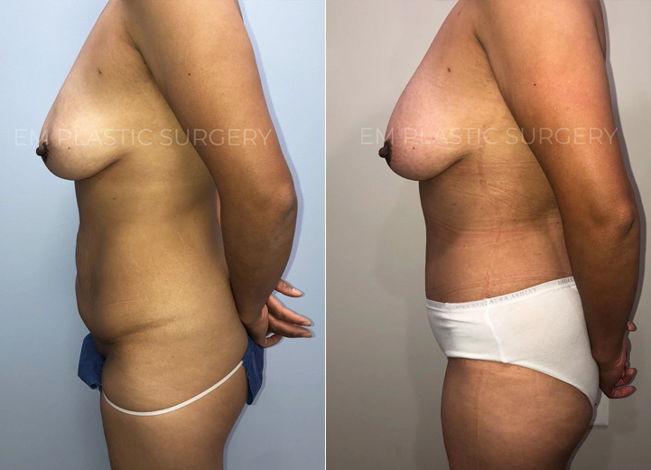 This is a 42-year-old woman who had multiple pregnancies in the past and had a complication
during one of her deliveries requiring an open abdominal surgery. Unfortunately, the surgery
resulted in significant scarring of her lower abdomen. She came to me wanting to get rid of the
extra belly tissue and scars. She underwent a full abdominoplasty with rectus plication. She was
so happy to have her flat abdomen back. Not only is her abdominal scar fully removed but a
good chunk of her stretch marks were also been removed, which was a nice plus.