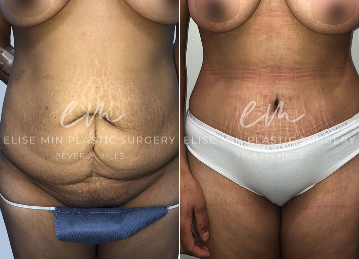 This is a 42-year-old woman who had multiple pregnancies in the past and had a complication during one of her deliveries requiring an open abdominal surgery. Unfortunately, the surgery resulted in significant scarring of her lower abdomen. She came to me wanting to get rid of the extra belly tissue and scars. She underwent a full abdominoplasty with rectus plication. She was so happy to have her flat abdomen back. Not only is her abdominal scar fully removed but a good chunk of her stretch marks were also been removed, which was a nice plus.