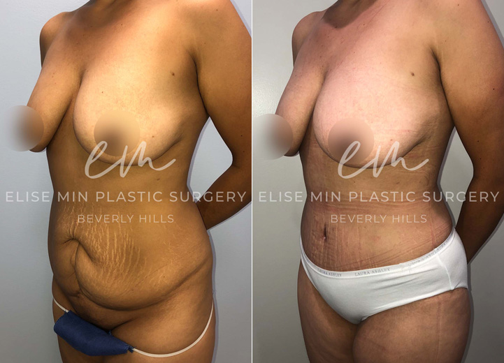 This is a 42-year-old woman who had multiple pregnancies in the past and had a complication during one of her deliveries requiring an open abdominal surgery. Unfortunately, the surgery resulted in significant scarring of her lower abdomen. She came to me wanting to get rid of the extra belly tissue and scars. She underwent a full abdominoplasty with rectus plication. She was so happy to have her flat abdomen back. Not only is her abdominal scar fully removed but a good chunk of her stretch marks were also been removed, which was a nice plus.