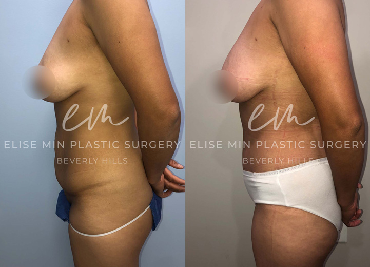 This is a 42-year-old woman who had multiple pregnancies in the past and had a complication during one of her deliveries requiring an open abdominal surgery. Unfortunately, the surgery resulted in significant scarring of her lower abdomen. She came to me wanting to get rid of the extra belly tissue and scars. She underwent a full abdominoplasty with rectus plication. She was so happy to have her flat abdomen back. Not only is her abdominal scar fully removed but a good chunk of her stretch marks were also been removed, which was a nice plus.