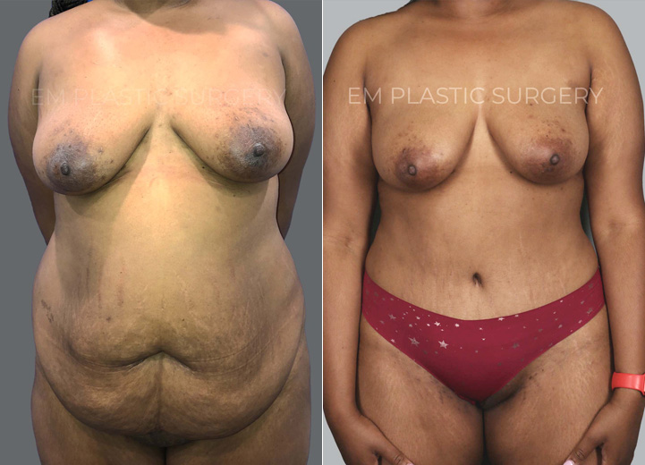 This is a 30-year-old woman who was fed up with the yo-yo effect of her weight loss journey
and could never get rid of the extra tissue hang of her lower belly. Although she had never been
pregnant before, she also had rectus diastasis from the weight fluctuations. She underwent a
full abdominoplasty with rectus plication and additional liposuction of the flanks. The surgery
transformed her life for the better. The only downside is that she had to buy a brand new
wardrobe of clothes, which she was excited to do.