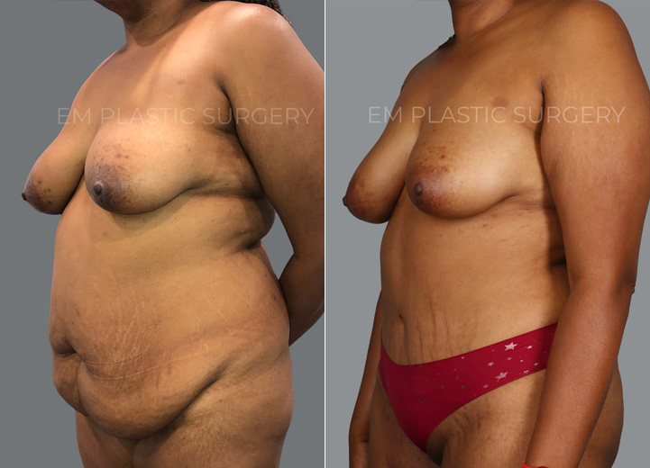 This is a 30-year-old woman who was fed up with the yo-yo effect of her weight loss journey
and could never get rid of the extra tissue hang of her lower belly. Although she had never been
pregnant before, she also had rectus diastasis from the weight fluctuations. She underwent a
full abdominoplasty with rectus plication and additional liposuction of the flanks. The surgery
transformed her life for the better. The only downside is that she had to buy a brand new
wardrobe of clothes, which she was excited to do.